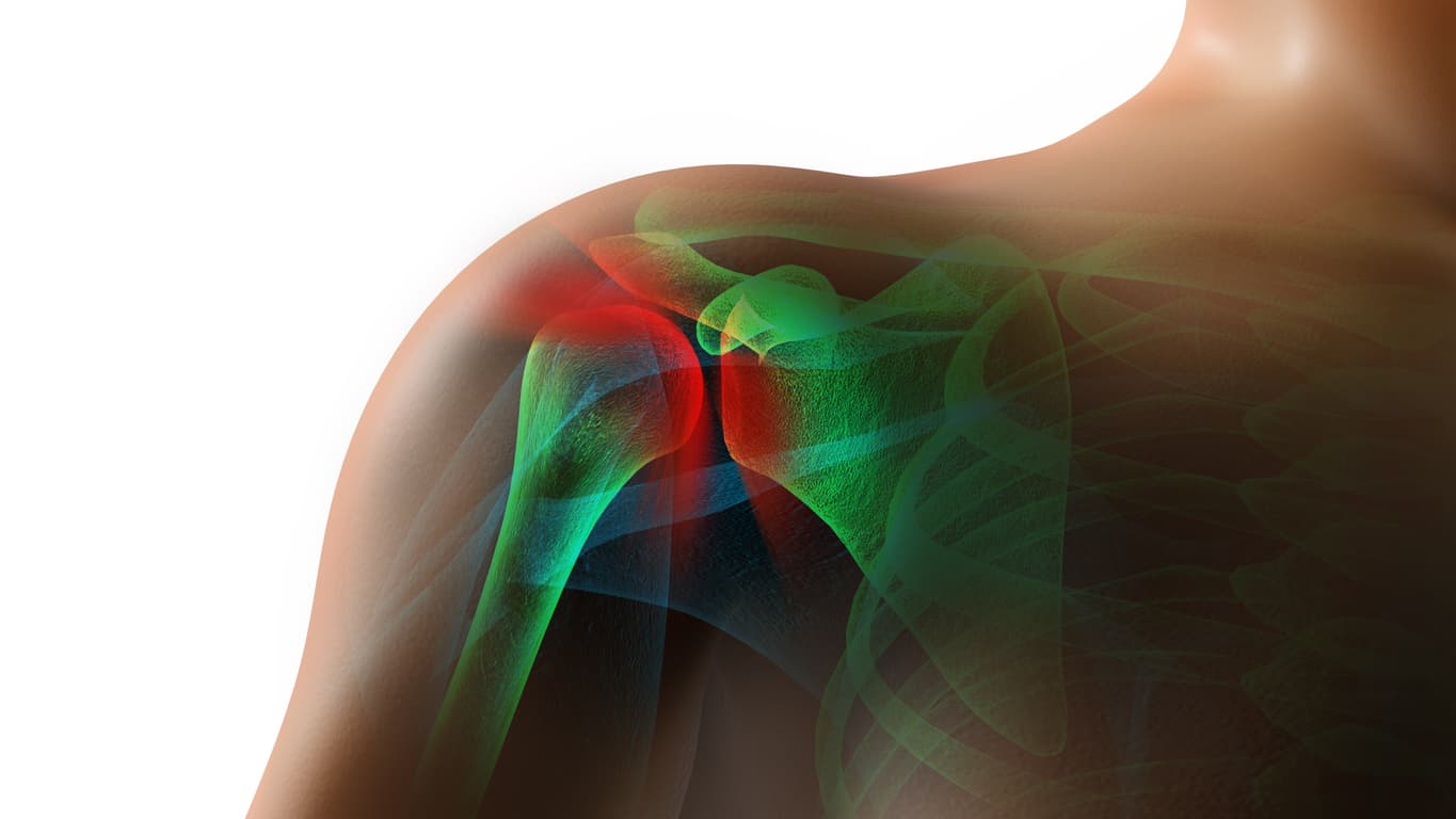 Torn Rotator Cuff After a St. Louis Car Accident